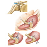 Open Acromioplasty (Partial Acromionectomy)