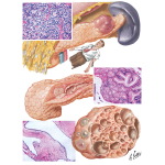Benign Tumors