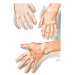 Early and Moderate Hand Involvement In Rheumatoid Arthritis