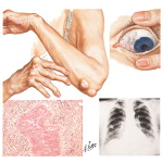Extraarticular Manifestations In Rheumatoid Arthritis