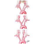 Normal and Anomalous Origins of Common Carotid and Vertebral Arteries