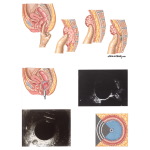 Diagnosis of Rectal Cancer