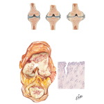 Joint Pathology In Osteoarthritis