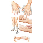 Joint Involvement In Juvenile Arthritis