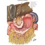 Spread of Carcinoma of Stomach