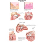 Bacterial Endocarditis