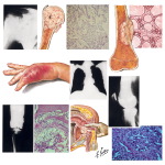 Tumors Metastatic to Bone