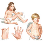 Systemic Juvenile Arthritis