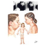 Sequelae of Juvenile Arthritis