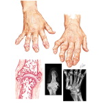 Hand Involvement In Osteoarthritis