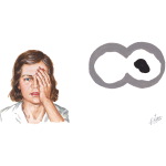 Multiple Sclerosis: Ocular Manifestations