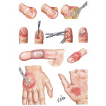 Cellulitis and Epidermal Abscess