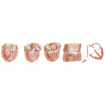 Uncommon Cardiac Mechanisms In Stroke