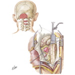 Posterior Approach for Vertebral and Posterior Inferior Cerebellar Aneurysms