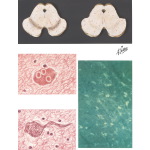 Neuropathy of Parkinson's Disease