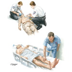 Lancet-Adams Syndrome (Posthypoxic Myoclonus)