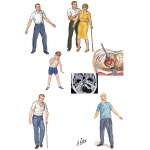Neurodegenerative Disorders