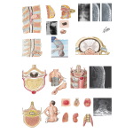 Acute Spinal Cord Syndromes: Pathology, Etiology, and Diagnosis