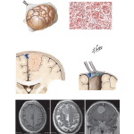 Meningiomas