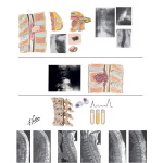 Extradural Spinal Tumors