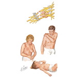 Brachial Plexopathy
