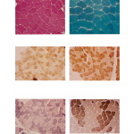 Sections From Muscle Biopsy Specimens