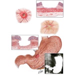 Subacute and Chronic Gastric Ulcers