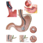 Therapeutic Endoscopy