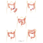 Abdominal Wounds of the Colon