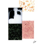 Legionnaires' Disease