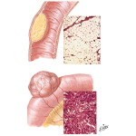 Benign Tumors