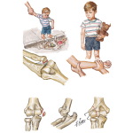 Elbow Injury In Children
