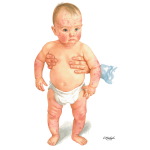 Infant With Atopic Dermatitis