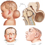 Defects of the Brain and Skull