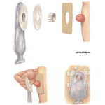 Ileostomy and Colostomy