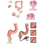 Neoplasms of the Large Bowel: Screening and Treatment of Colon Polyps