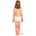 Child With Atopic Dermatitis - Dorsal View