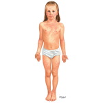 Child With Atopic Dermatitis - Frontal View