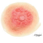 Nipple Eczema