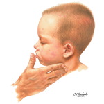 Lymphadenopathy In a Child With Atopic Dermatitis