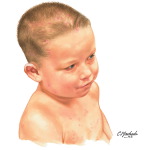 Scalp Dermatitis In a Child (Scalp Cap)