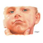 Face Xerosis