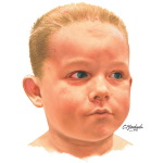 Conjunctivitis Eyelid Inflammation