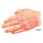 Hand Dermatitis