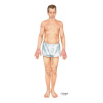 Adult Patient With Atopic Dermatitis of the Hands