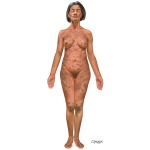 Atopic Dermatitis Coexisting With Allergic Contact Dermatitis