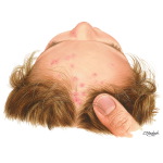 Atopic Dermatitis of the Scalp
