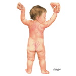 Child With Scabies - Dorsal View