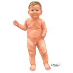Child With Scabies - Frontal View
