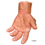 Allergic Contact Dermatitis